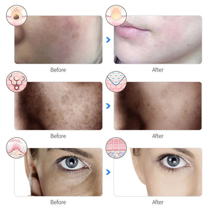 Anti Acne Wrinkle Removal Beauty Mask Skin Brightenin