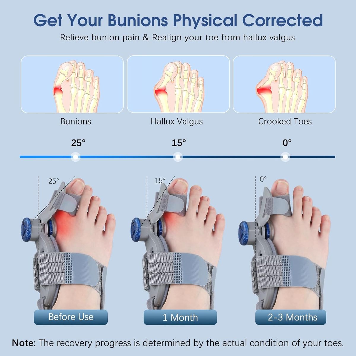 FeetifFix - Bunion Corrector